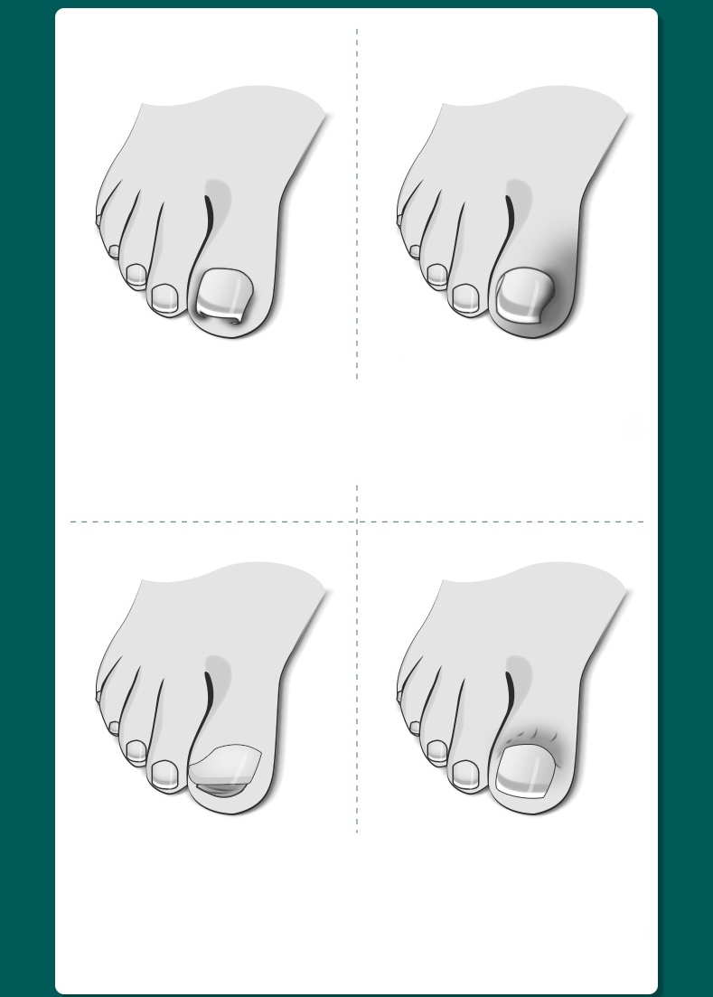 TransForMacion Pedikür Makası Tırnak Batık Makası Tungsten Çelik Profesyonel 721101
