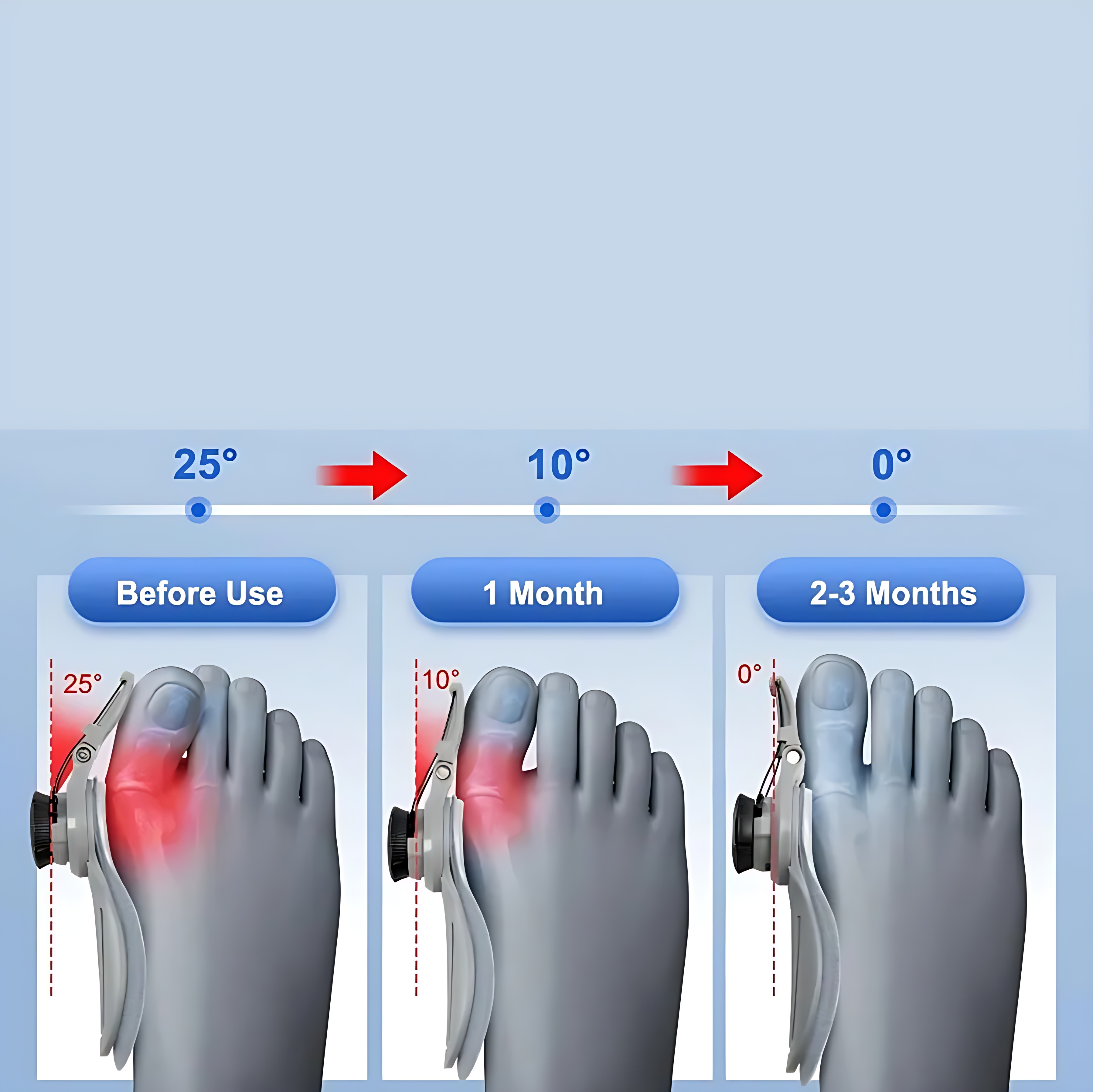Pro-Adjust Ayarlanabilir Mekanizmalı Bunyo n Düzeltici - Ortopedik Gece ve Gündüz Ateli 722657